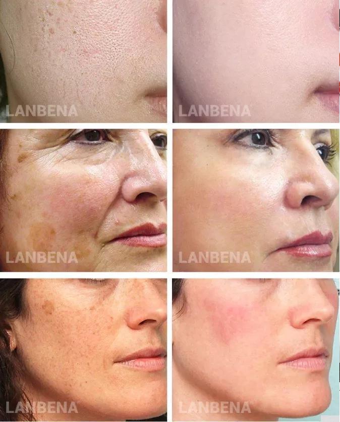 Lanbena® - Serum Completo Vitamina C + Ácido Hialurônico Botox Ouro Kit