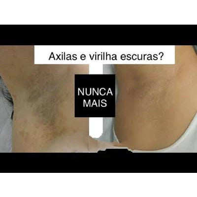 Kit Micosan Clareador de Manchas escuras Original