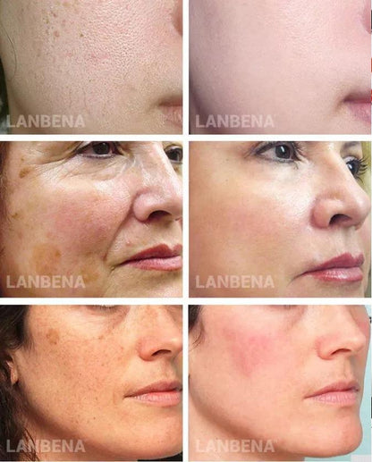 Lanbena® - Serum Completo Vitamina C + Ácido Hialurônico Botox Ouro Kit