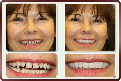 Facetas Odontológicas Removíveis - SmileVeneers